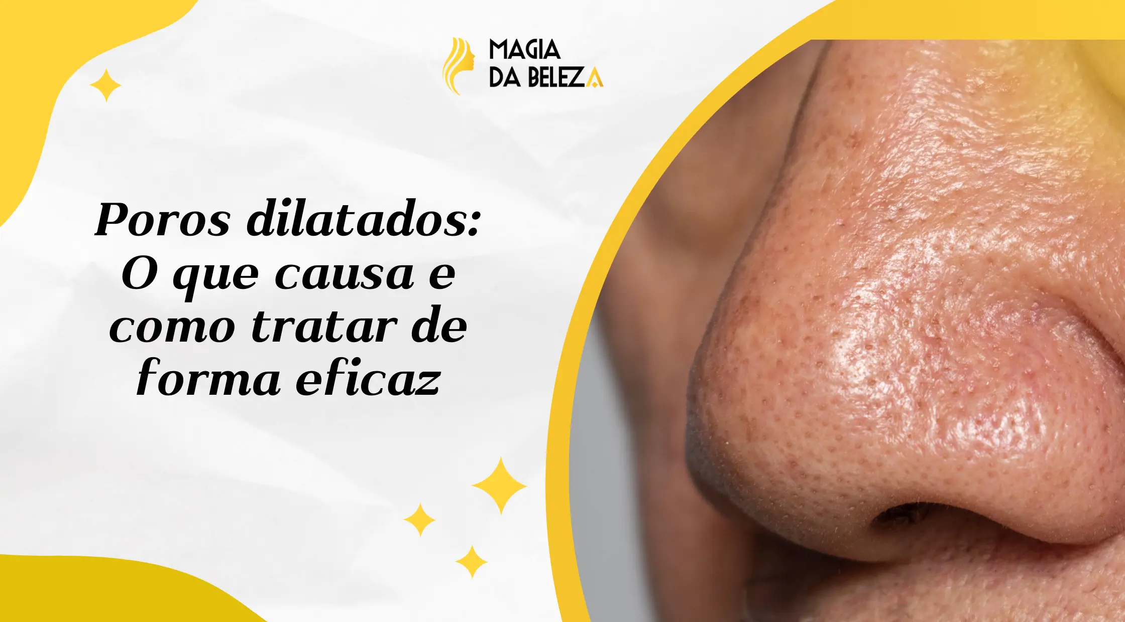 Poros dilatados: O que causa e como tratar de forma eficaz