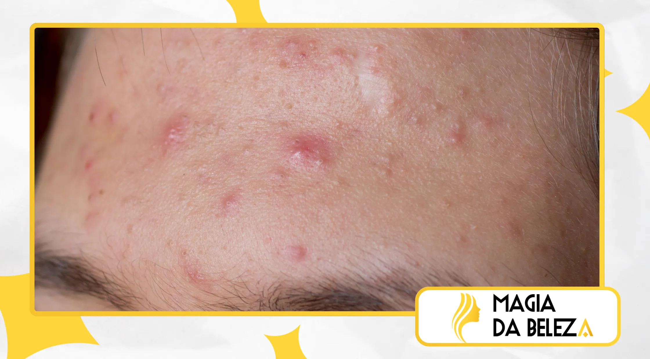 Como Tratar Acne e Espinhas com uma Rotina de Skincare Adequada