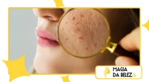 Microbioma da pele